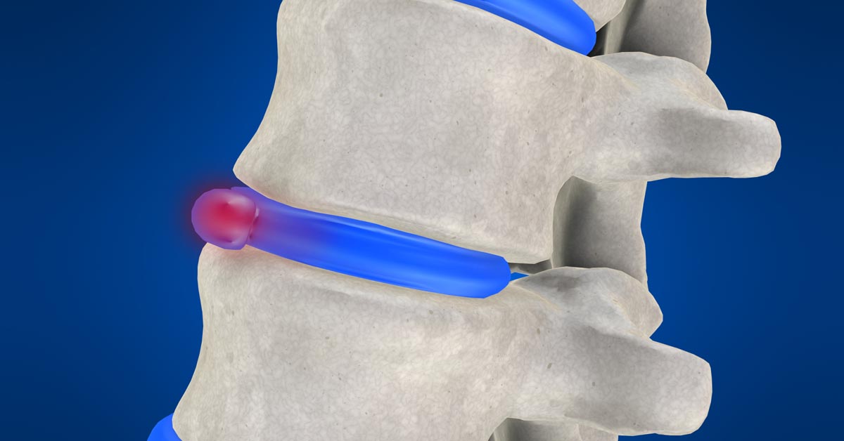 Arlington non-surgical disc herniation treatment