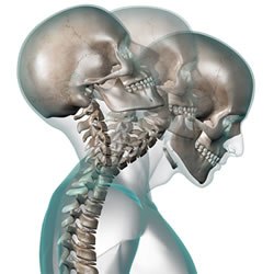 Arlington, WA Auto Injury Chiropractor